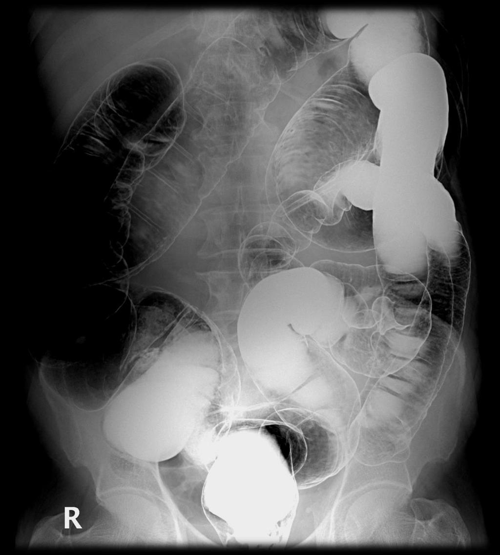 Radiograph of the abdomen: Double contrast study* 5 4 6 3 7 2 8 1 1. Rectum. 2.Sigmoid colon. 3. Descending colon. 4. Splenic flexure.