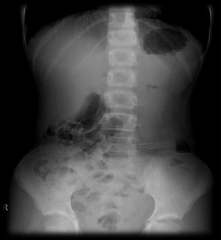 Normal abdominal X-ray* Right side Left side Right side Left side Standing Supine 3 2 1 1-