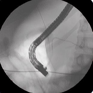 Designed to facilitate access and control during endoscopic retrograde cholangiopancreatography (ERCP), the : Puts the physician in control of the guidewire.