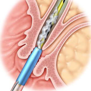 Complications and Physician-controlled wireguided cannulation reduces the risk of post-ercp pancreatitis compared with the standard contrast injection method.