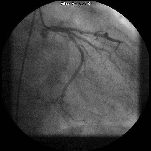 Our patient RG: Left coronary artery branches on coronary angiogram LCx LAD Green arrows