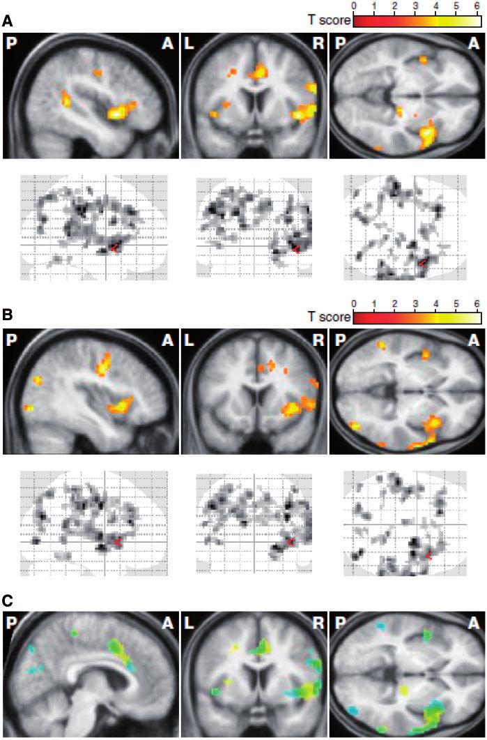 Emotion processing in pre-manifest Huntington s disease Brain 2012: 135; 1165 1179 1173 Figure 2 Statistical parametric maps showing the negative correlations between pre-manifest HD levels of BOLD