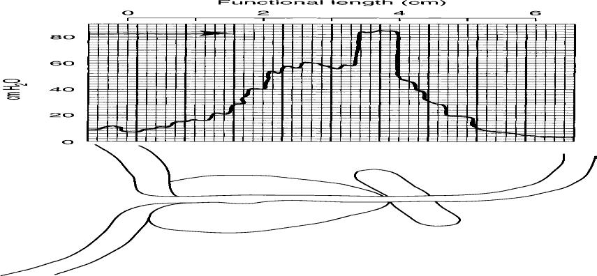 Urinary sphincteric function can be evaluated by recording the electromyographic(emg) and profilometry 3.