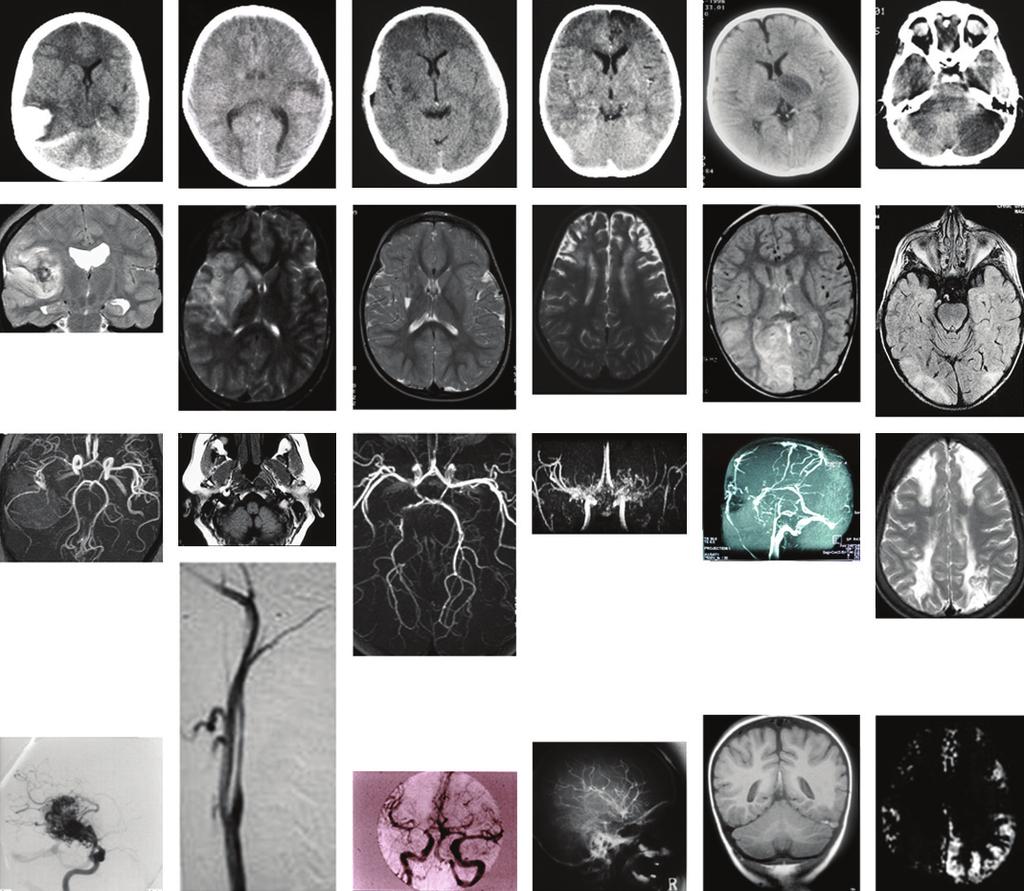 Downloaded from ad.bmj.om on January 15, 2011 - Published by group.bmj.om Figure 1 Neuroimaging in hildren with stroke.
