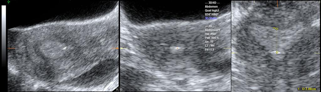 Assessment of embryo flash position and migration with 3D ultrasound 593 Figure 1 Example of an embryo flash assessment following 3D ultrasound acquisition.
