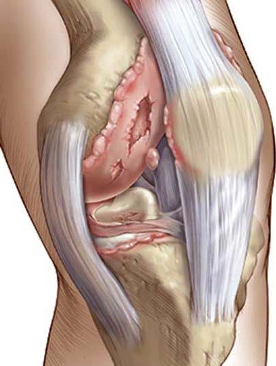 Arthritic knee joint The cartilage has thinned and