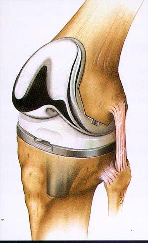 Knee replacement Relieves pain, restores