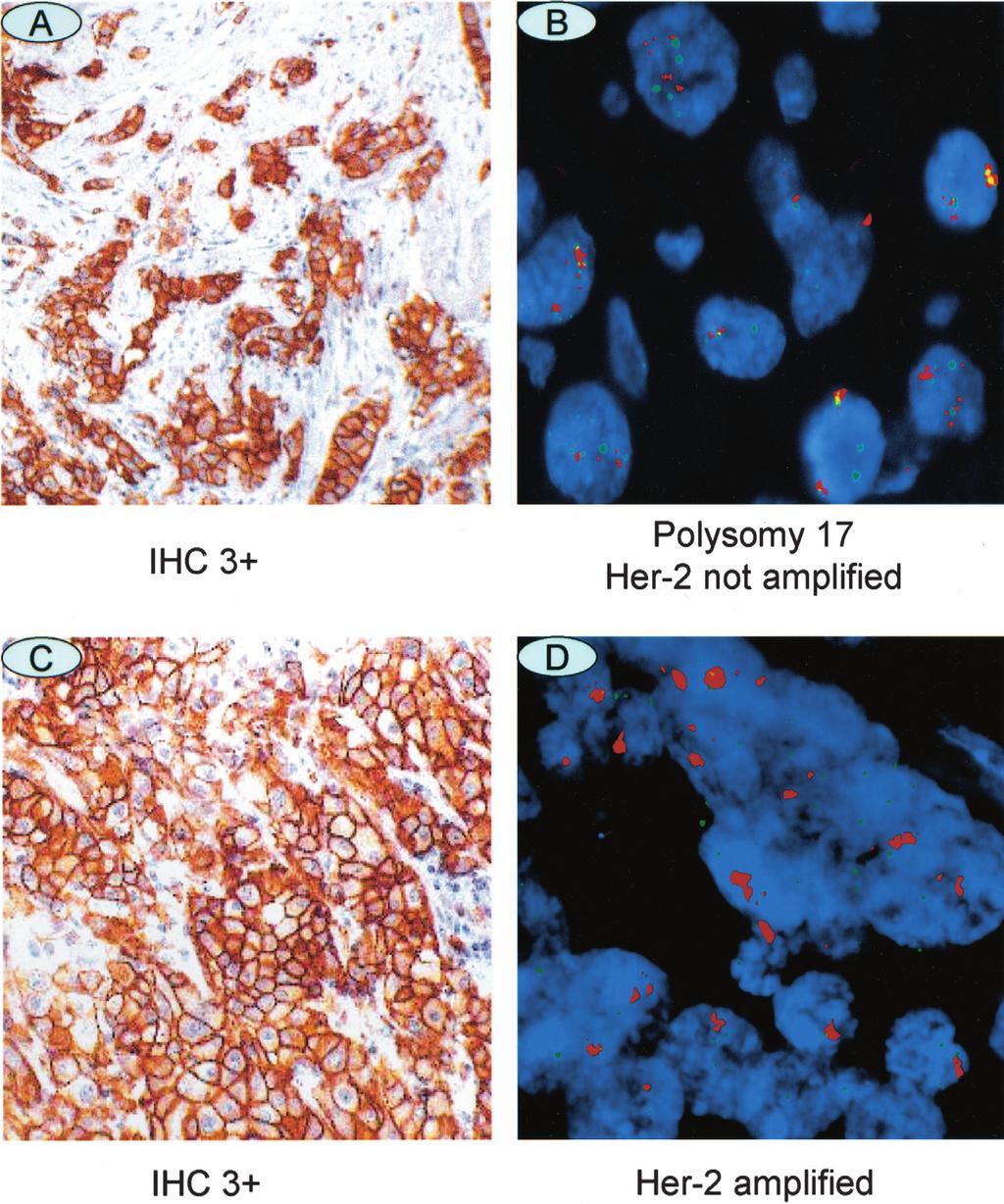 Impact of Polysomy 17 on Her-2/neu Immunohistochemistry 157 Figure 1. Representative examples of IHC ( 10) and FISH ( 100) images of Her-2/neu. A and B: A case of IHC 3 /FISH-negative.