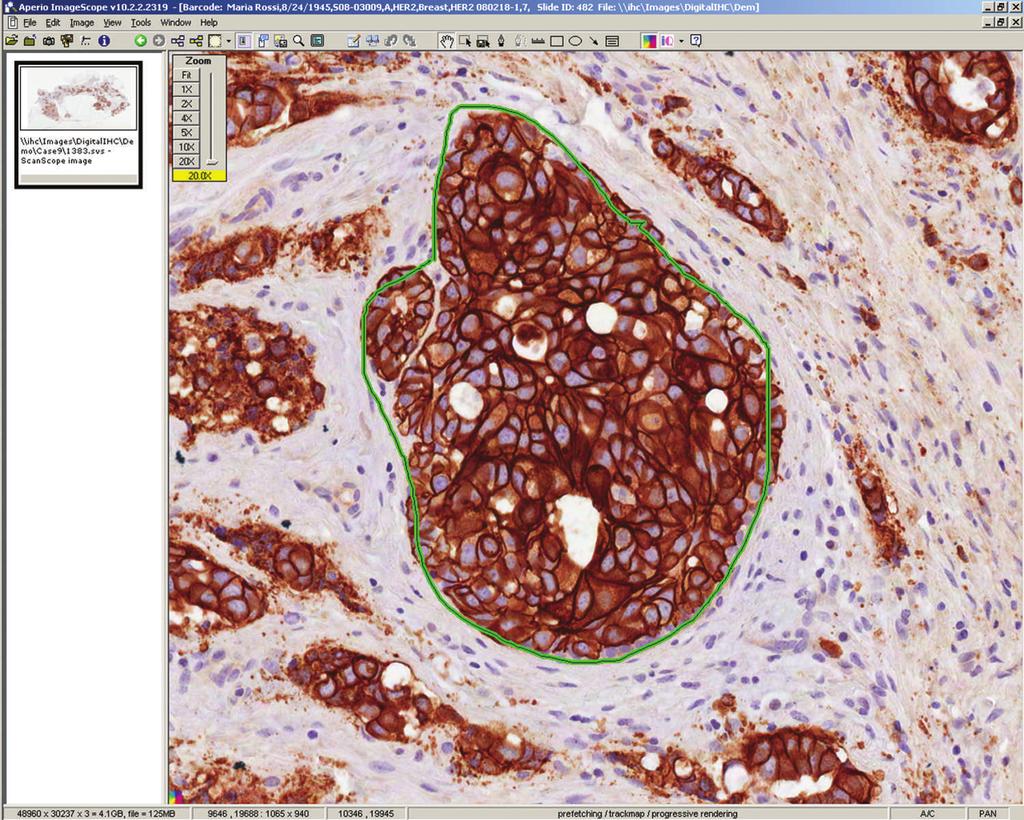 Figure 3. Captured image of a HER2/neuimmunostained slide on a computer monitor with annotations by the pathologist. 20 minutes before staining.