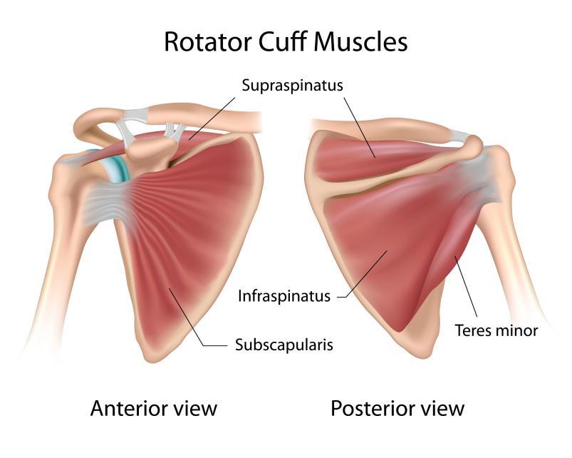 In an arthritic shoulder, the normal cartilage (smooth surface of joint) is worn away, and there is bone-on-bone without the
