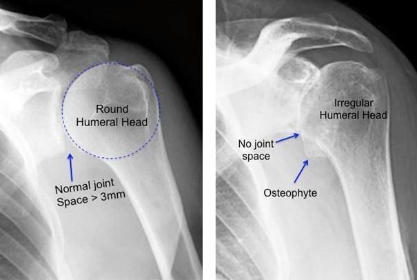 The joint may also become irregular from boney growth (osteophytes), which is the body's attempt to "heal" the cartilage injury.