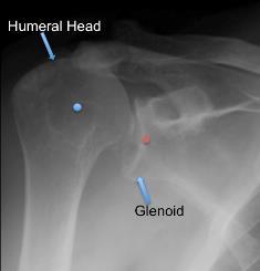 Without normal function of the rotator cuff, the humeral head may move upward out of the glenoid