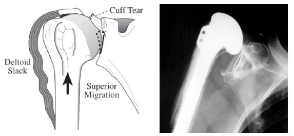 If a total shoulder replacement is used in this situation, the humeral head usually remains upward