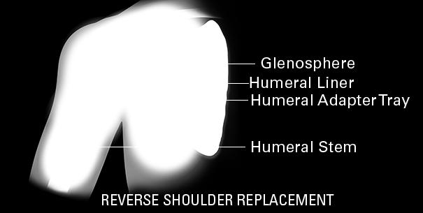 The reverse total shoulder replacement changes the orientation of the shoulder so that the normal socket (glenoid) now is replaced with an artificial ball, and the normal ball (humeral