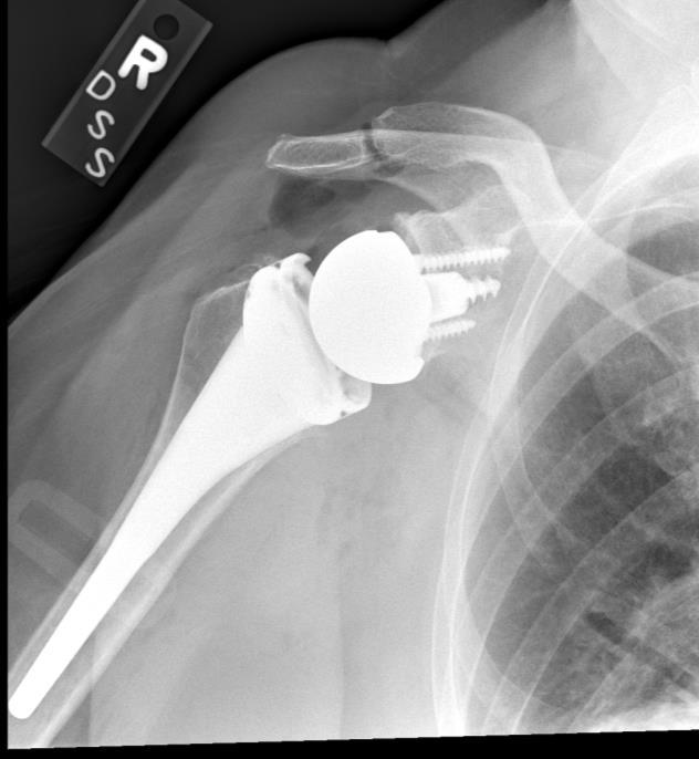 This type of design completely changes the mechanics of the shoulder and enables the artificial joint to function when the rotator cuff is either absent or when there is significant