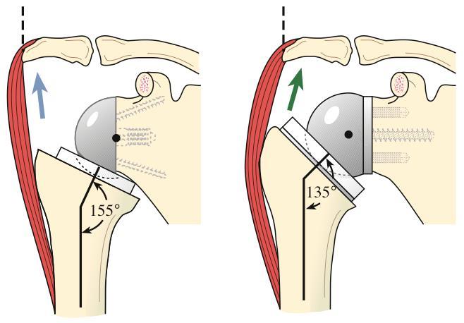 The benefit of the reversal of the shoulder joint is that it allows the deltoid muscle to lift the shoulder