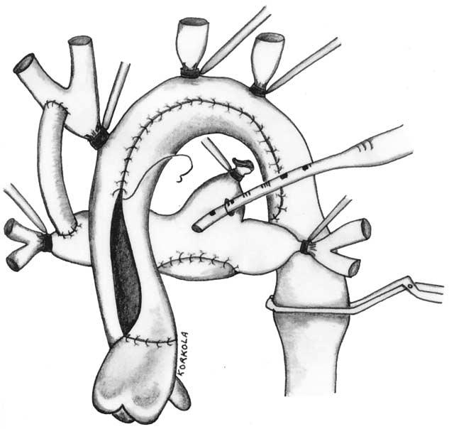 A clamp is placed on the descending thoracic aorta and the left subclavian and carotid arteries are snared while continuous low-flow cerebral perfusion is maintained through the innominate artery.