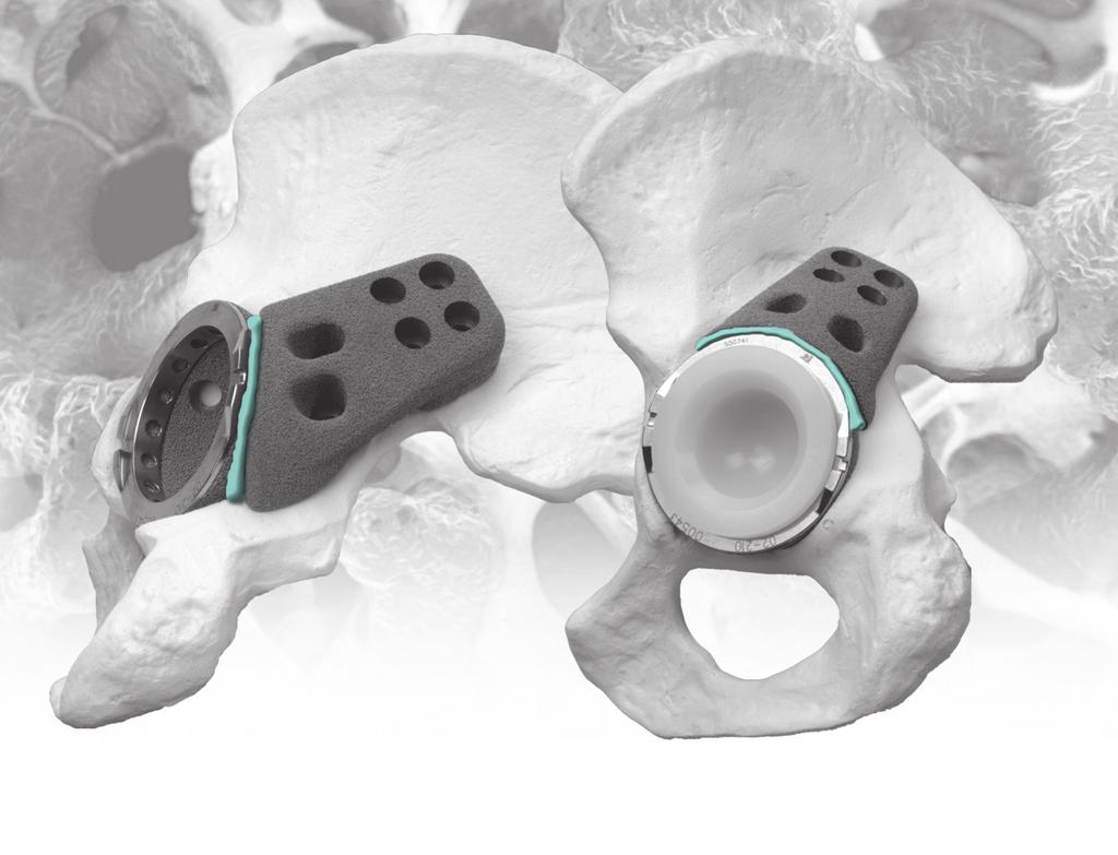 2 Trabecular Metal Acetabular Revision System Buttress and Shim Augments A Viable Alternative To Structural Allograft Give Bone a Solid Hold The Straight