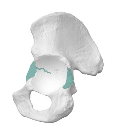 Trabecular Metal Acetabular Revision System Buttress and Shim Augments 3 Preoperative Planning The Paprosky classification system is based on the severity of bone loss and the ability to obtain