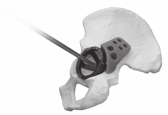 4 Trabecular Metal Acetabular Revision System Buttress and Shim Augments 2Choose the Appropriate Component Insert the selected size Trabecular Metal Revision Shell Provisional to determine areas