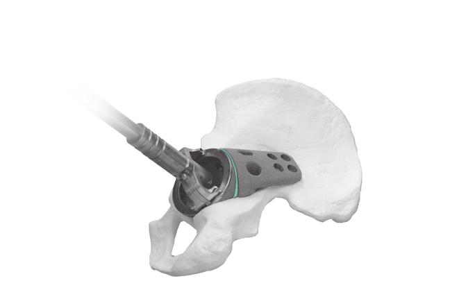 Trabecular Metal Acetabular Revision System Buttress and Shim Augments 7 5Implant the Revision Shell Attach the cup inserter to the rim of the selected Trabecular Metal Revision Shell.