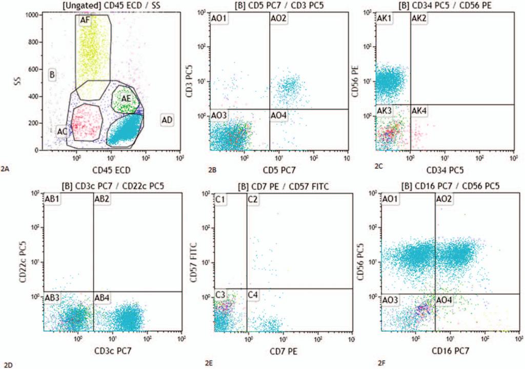 Figure 2. Flow cytometry of the patient before treatment shows that most of the neoplastic cells are in cyan. A small population of surface CD3 þ and CD5 þ normal T cells is present in the background.