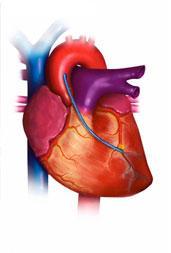Myocardial Infarction Type 5 CABG-related MI is defined by elevation of cardiac troponin values >10 X 99 th percentile URL.