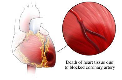Definition of myocardial infarction Acute myocardial infarction is