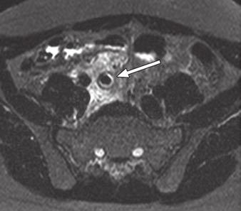MRI of Suspected ppendicitis fter Inconclusive Ultrasound TBLE 1: ppendix MRI Parameters, by Sequence and Magnet Strength Sequence, Magnet Strength TR/TE Slice Thickness (mm) Gap (mm) Coronal