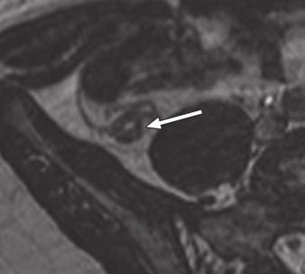 00 (Pe, 0.695). The normal appendix was identified in 83% of cases by reader 1 (35/41 [85%] at 1.5-T MRI and 5/7 [71%] at 3-T MRI) and in 88% of the cases by reader 2 (36/41 [88] at 1.