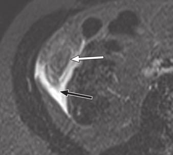 3 16-year-old girl with abdominal pain, not otherwise specified. Normal retrocecal appendix (arrow) is seen on 3-T coronal HSTE image.