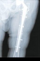 Evidence of femoral stress shielding and acetabular loosening stage IIC.