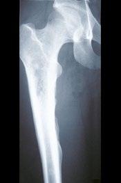 X-rays show consolidation and preserved distal femoral trophicity.