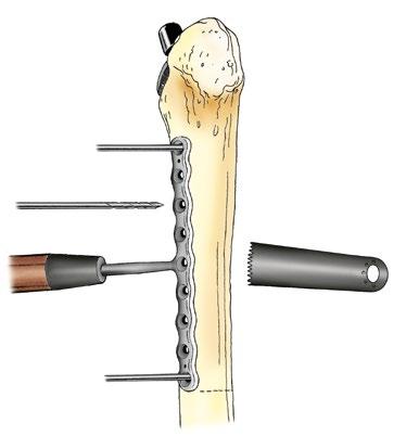 Approach Extended Trochanteric Osteotomy Regardless of the initial approach selected (posterior, lateral or anterior), it is obligatory that the approach be made via the transfemoral route (Wagner