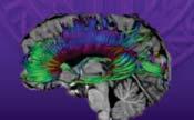Functional MRI (fmri) Diffusion Tensor Imaging (DTI) MR-Spectroscopy (MRS) McCrory P et al.