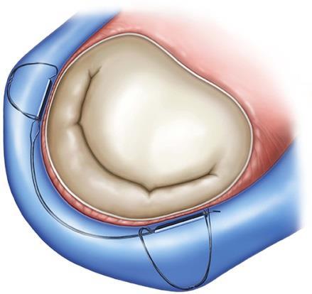 We believe that the Carillon s coronary sinus approach, with its ability to be repositionable, removable, and easy to implant, should make it part of the primary treatment paradigm compared to