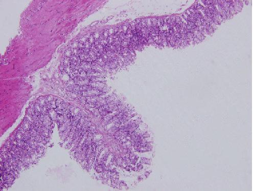 Mucosa and submucosa defects could be seen with infiltrations of inflammatory neutrophils and lymphocytes in the lamina propria of the model group on day 14.