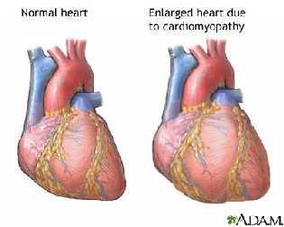 Indications for cardiothoracic transplantation Heart Adults - idiopathic dilated cardiomyopathy, ischaemic cardiomyopathy.