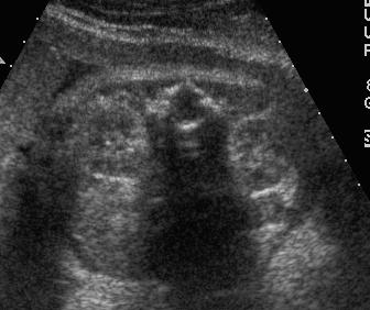 Chapter 6: Genitourinary and Gastrointestinal Systems 94 Normal Sonographic Anatomy KIDNEYS: Can be identified as early as 12-14 weeks as two relatively sonolucent structures adjacent