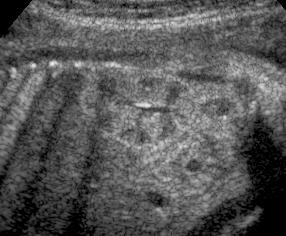 Occasionally the renal pelvis may contain a small amount of fluid. Normal finding and does not indicate obstructive uropathy. Seen in 18% of fetuses after 24 weeks.