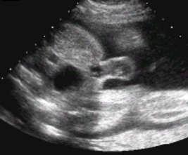 anomaly BLADDER: Can be identified routinely by 20 weeks. Its presence is an important indicator of active renal function. Transversely, iliac wings are important landmarks.