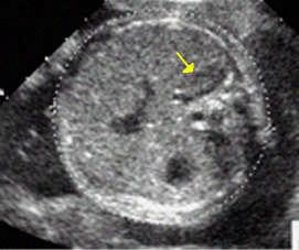 ADRENAL: relatively large in fetus. 90% is cortex and quickly involutes after birth. Seen as an oval mass of echo-poor tissue lying superior to the kidney on sagittal scan.