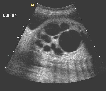 (coronal) Center: brightly echogenic, enlarged kidney seen adjacent to the