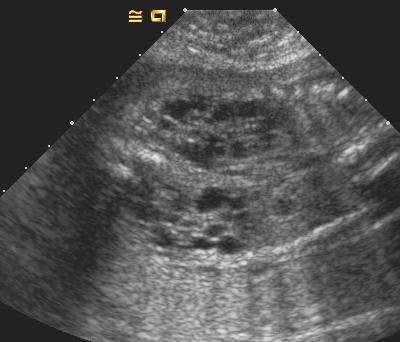 3cm) polycystic kidney Multicystic dysplastic kidney Congenital renal