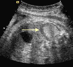 Presence of a solid mass in the renal fossa Differentiation is usually not possible with ultrasound Obstructive uropathies may vary in location, degree, severity and chronicity.