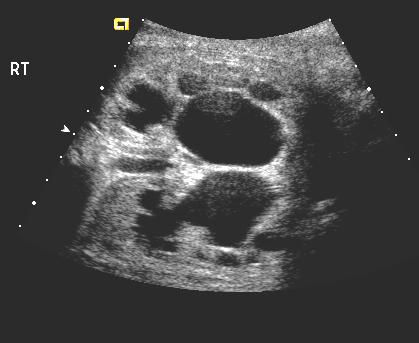 Demonstration of a dilated renal pelvis Presence of variable caliectasis Thinning of renal cortex in chronic states Posterior urethral valves Most common cause of urinary obstruction in male infants.