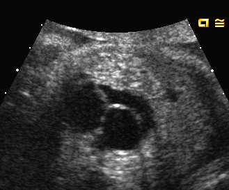 Marked hydronephrosis and a dilated, tortuous ureter Bladder wall thickening Male gender identified Ectopic ureterocele Developmental anomaly.
