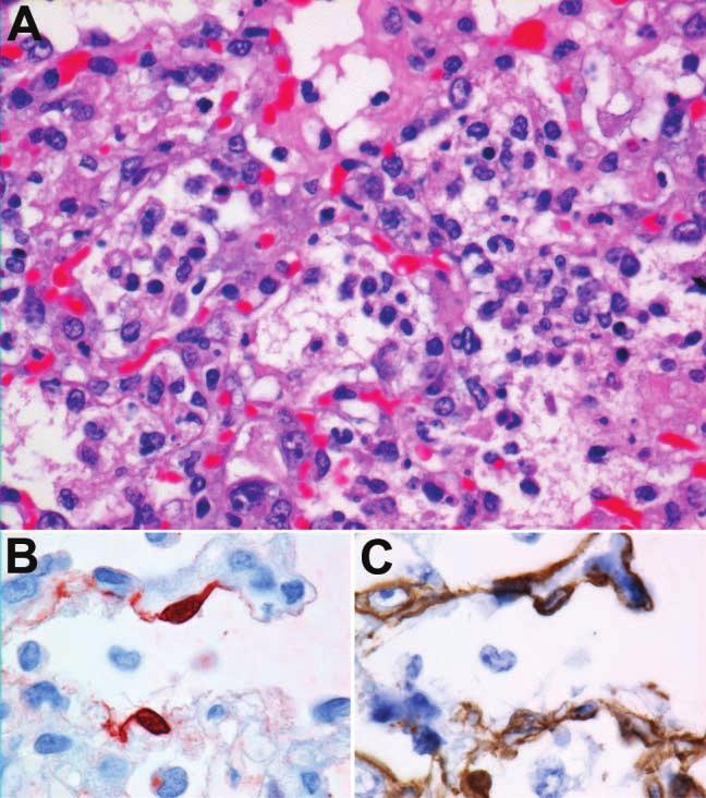 Figure 4. Diffuse alveolar damage in a ferret inoculated with new H1N1 virus.