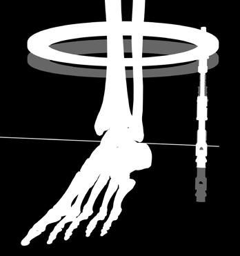 A guide wire is used to define the axis of rotation of the ankle joint.