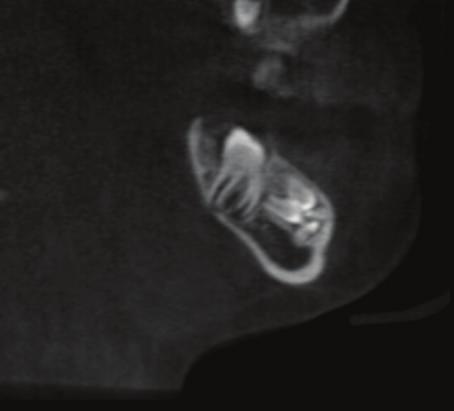 Figure 3: Florid cemento-osseous dysplasia seen as mixed predominantly radiolucent lesions seen in the periapical regions of most of the teeth in the maxillae and the mandible on this panoramic